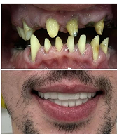 Before and after implantology treatment