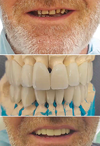Before and after prosthodontics treatment