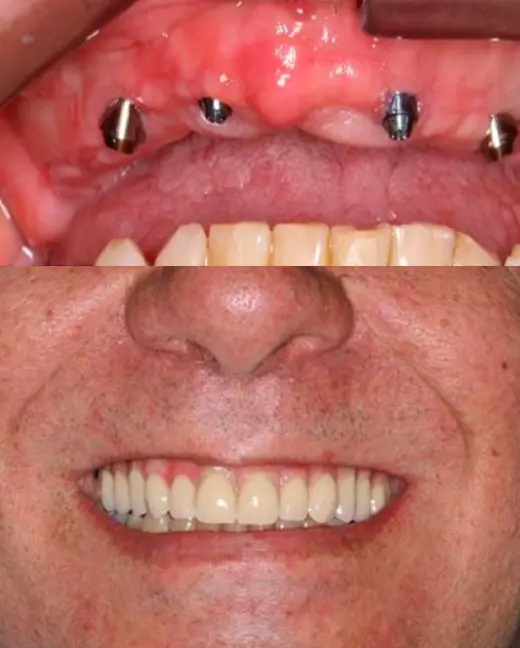 Restauracija Slučaj 1